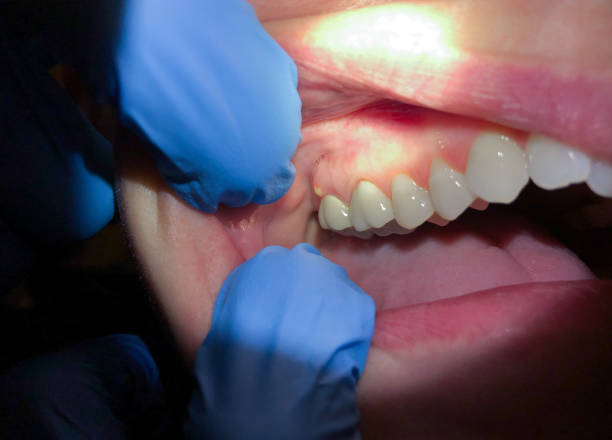 Best Emergency Care for Gum Disease in Haddon Heights, NJ